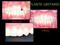 093-implante-unitario