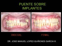 094-protesis-sobre-implantes