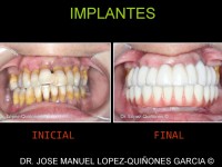095-implantes